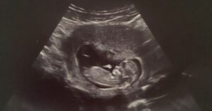 ITP en zwangerschap echo