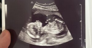 ITP en zwangerschap echo