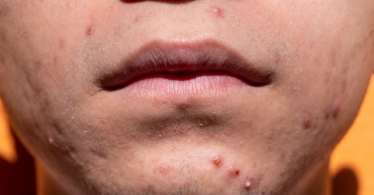 acne